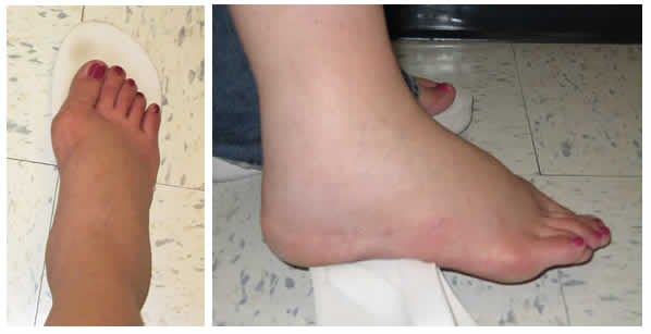 The Pregnancy Feet I Used to Deal With A Serious Case of Edema! Heidi Powell