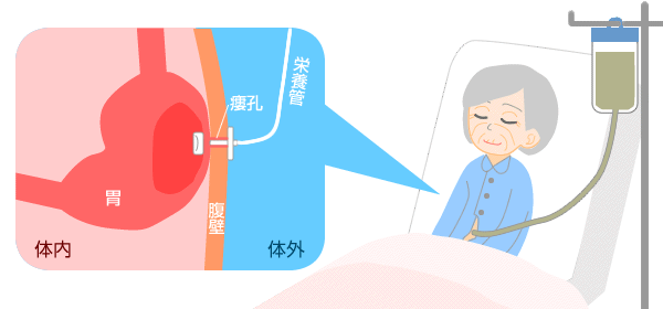 胃瘻（いろう）とは