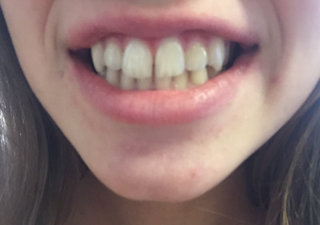 Charcoal teeth whitener Does it actually work?! Hellgate Lance