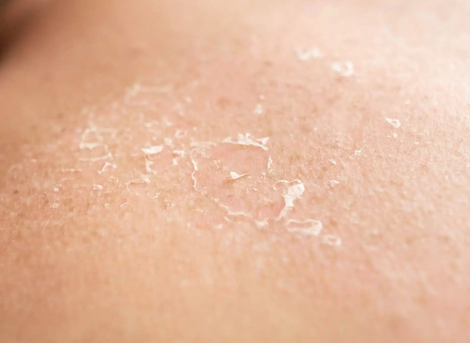 Why does sunburned skin peel in sheets? Hello Betty Company