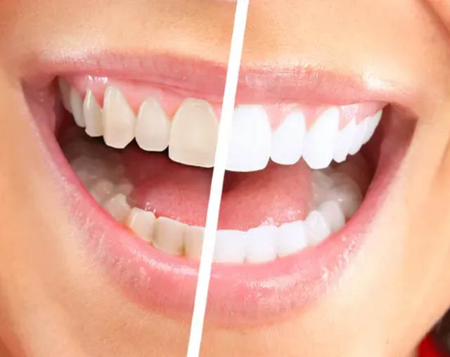 Teeth Whitening Teeth Whitening Brooklyn Teeth Whitening