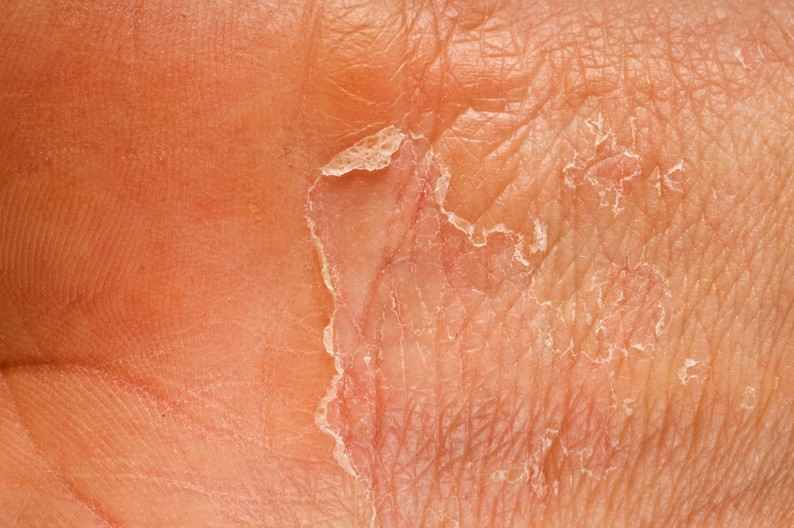 Exfoliative Keratolysis Health and Medical Articles HelloMrDoctor