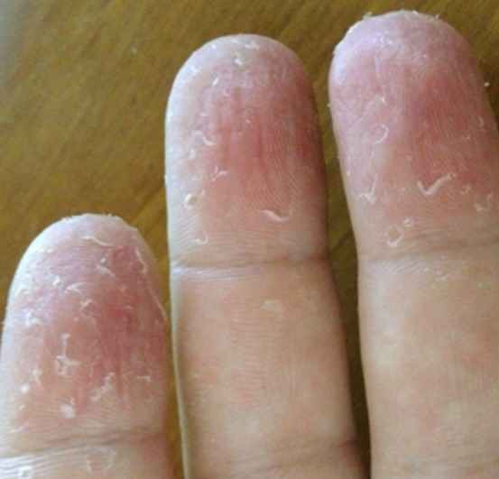 Exfoliative Keratolysis Causes, Pictures, Treatment, Remedies