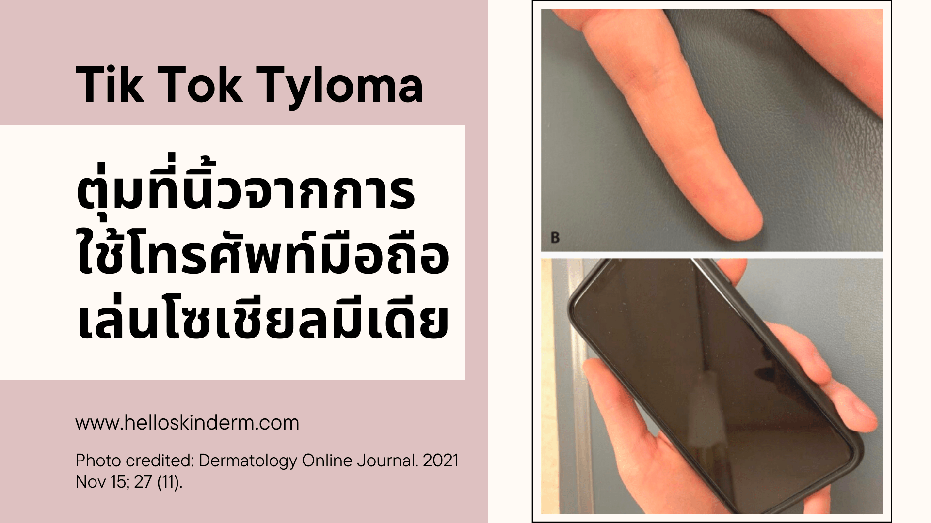 “Tik Tok Tyloma” ตุ่มที่นิ้วจากการเล่นโซเชียลมีเดียประจำ HELLO SKIN