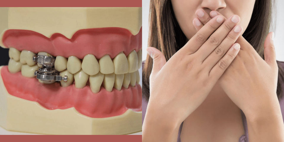 A weight loss device that locks jaw nearly shut, receives backlash