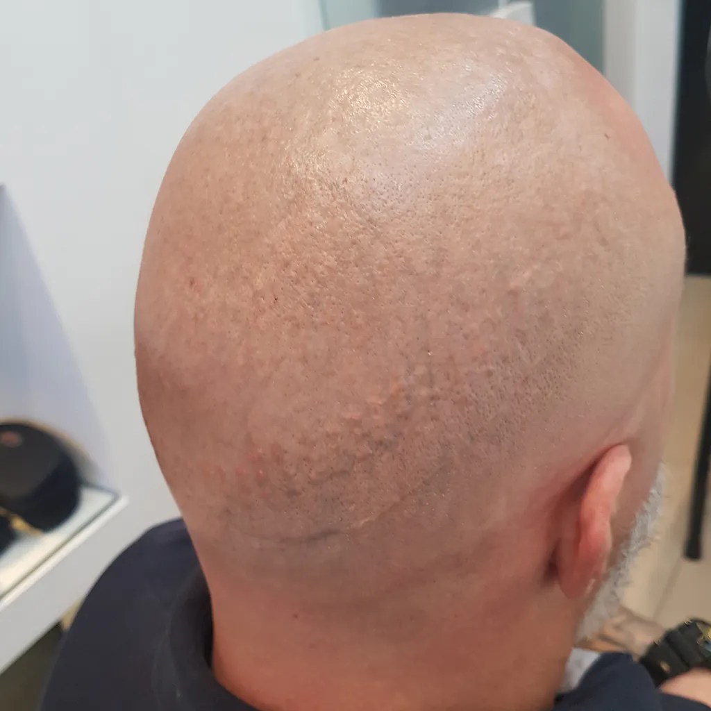 Bem Estar Tatuagem pode ser removida pouco tempo depois de feita, diz Remoção de tatuagens e resultados Hell Tattoo