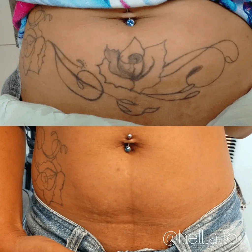 Jovem compartilha fotos de “remoção de tatuagem que deu errado” VEJA remoção de tatuagem na barriga Hell Tattoo Tatuagens, Remoção