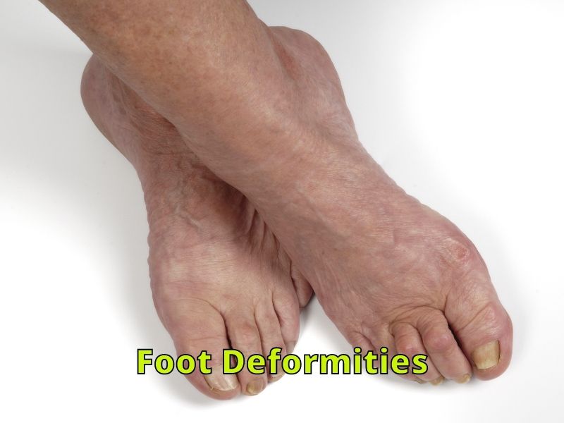 Why Do I have Wide Feet? Help Shoe