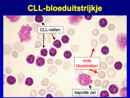 Chronisch Lymfatische Leukemie (Cll) - Hematologie Groningen