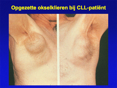 Chronisch Lymfatische Leukemie (Cll) - Hematologie Groningen