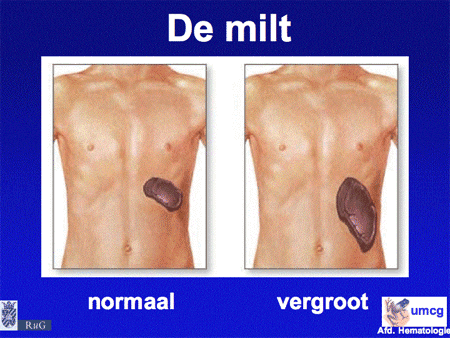 Chronisch Lymfatische Leukemie (Cll) - Hematologie Groningen