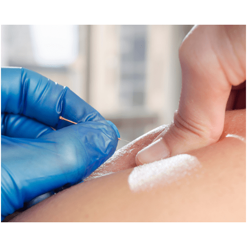 Dry Needling Hempstead Therapy Centre