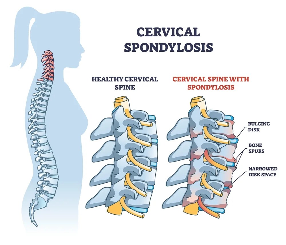 Top 7 Best Exercises For Cervical Spondylosis To Reduce Pain