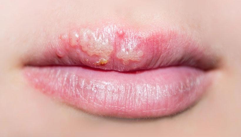 HSV1 and Cold Sore online treatment Herp Alert