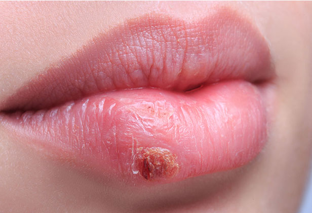 Cold Sores Online Treatment Herpes Simplex 1 Treatment Herp Alert