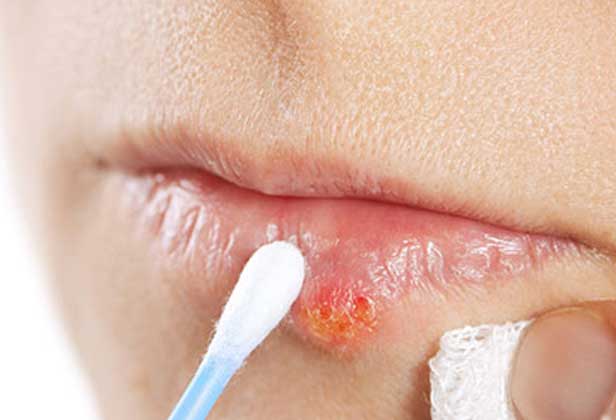 Cold Sores Online Treatment Herpes Simplex 1 Treatment Herp Alert