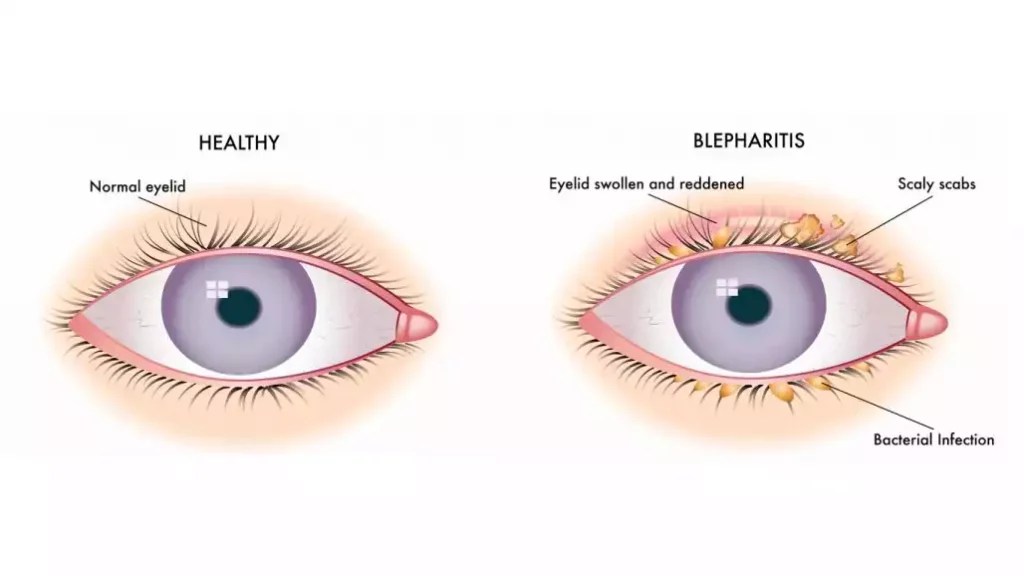 Blepharitis Lash Extensions How to Avoid It?