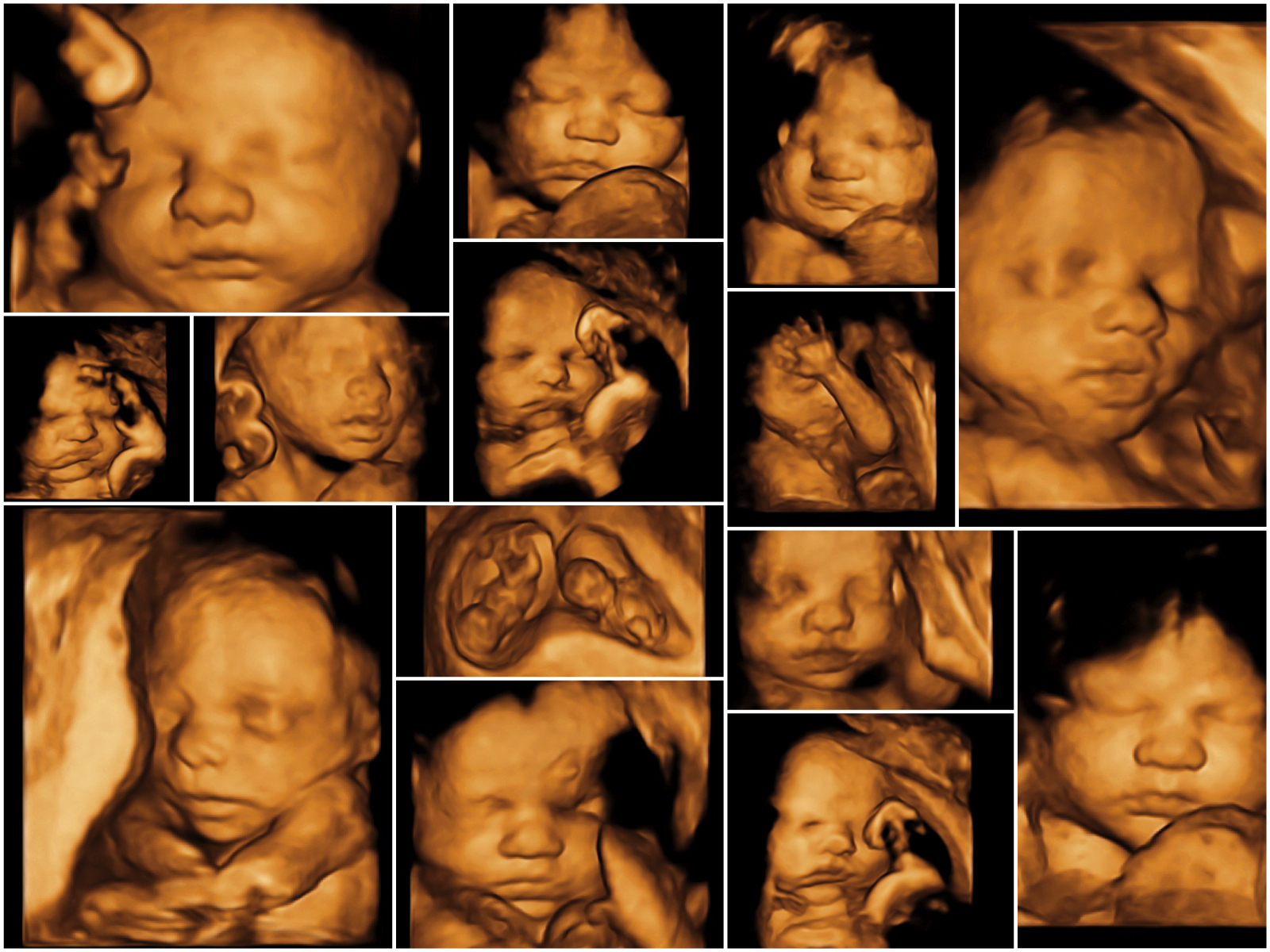 Kelowna 3D Ultrasound at Leann Baker blog