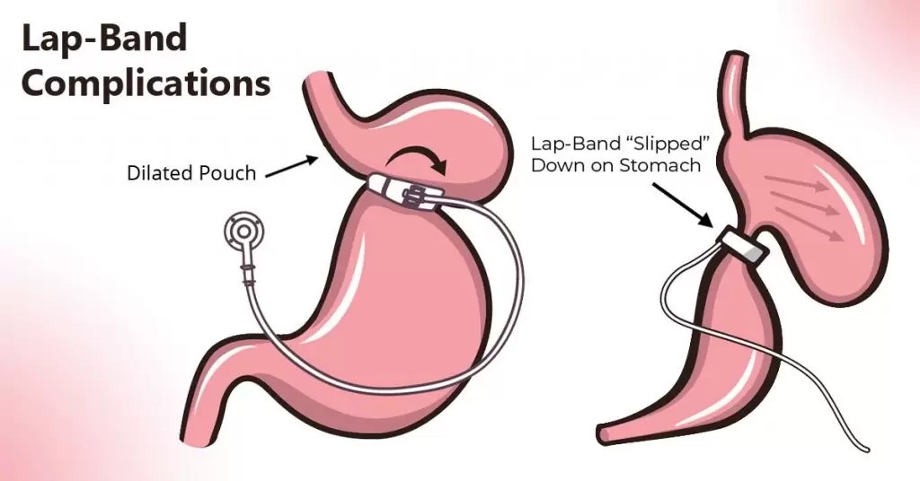 Why Lap Band Surgery not a good idea for everybody