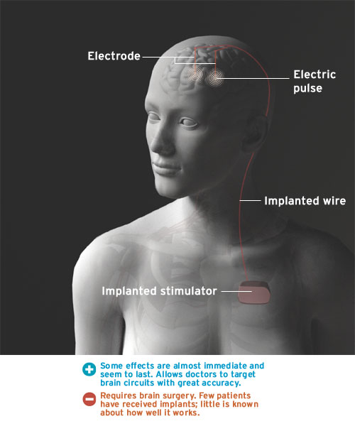 Electrodes Implanted Deep Within the Brain to Relief Depression HIGH T3CH
