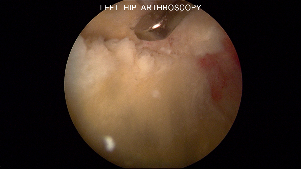 Limited Arthritis / Focal Cartilage Damage Dominic