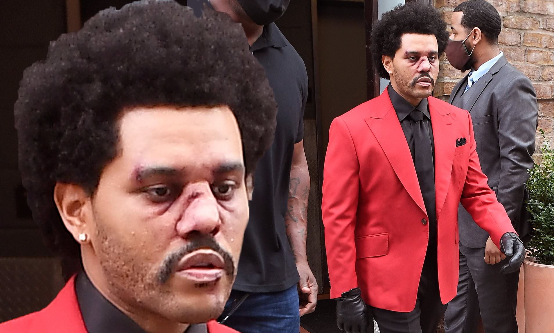 The Weekend Wears Bandages On AMA!!! Hip Hop News Uncensored