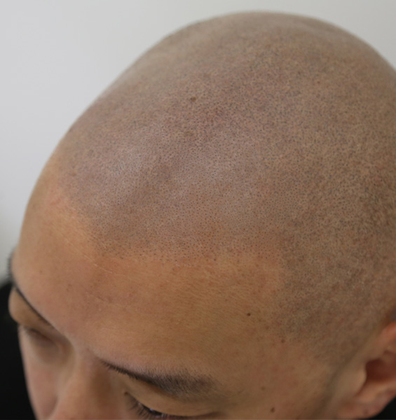 ヘアタトゥーとは(頭部への刺青)やり方|SPJ