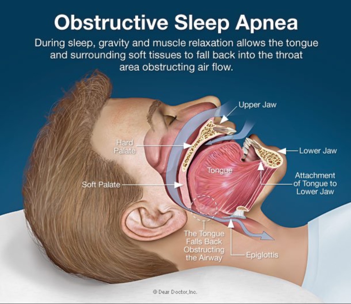 What is Sleep Apnea? Dr. Ismail