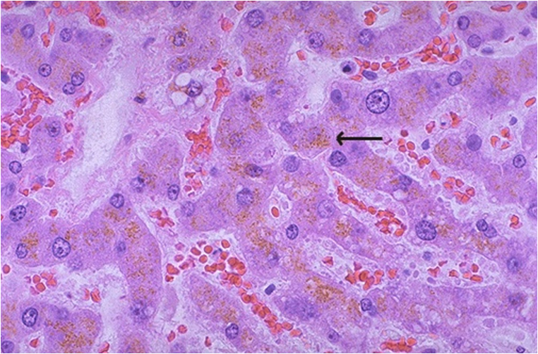 Image 24 Lipofuscin hepatocytes