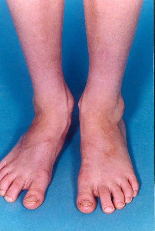 Juvenile Scleroderma Types, Causes, Symptoms, Diagnosis