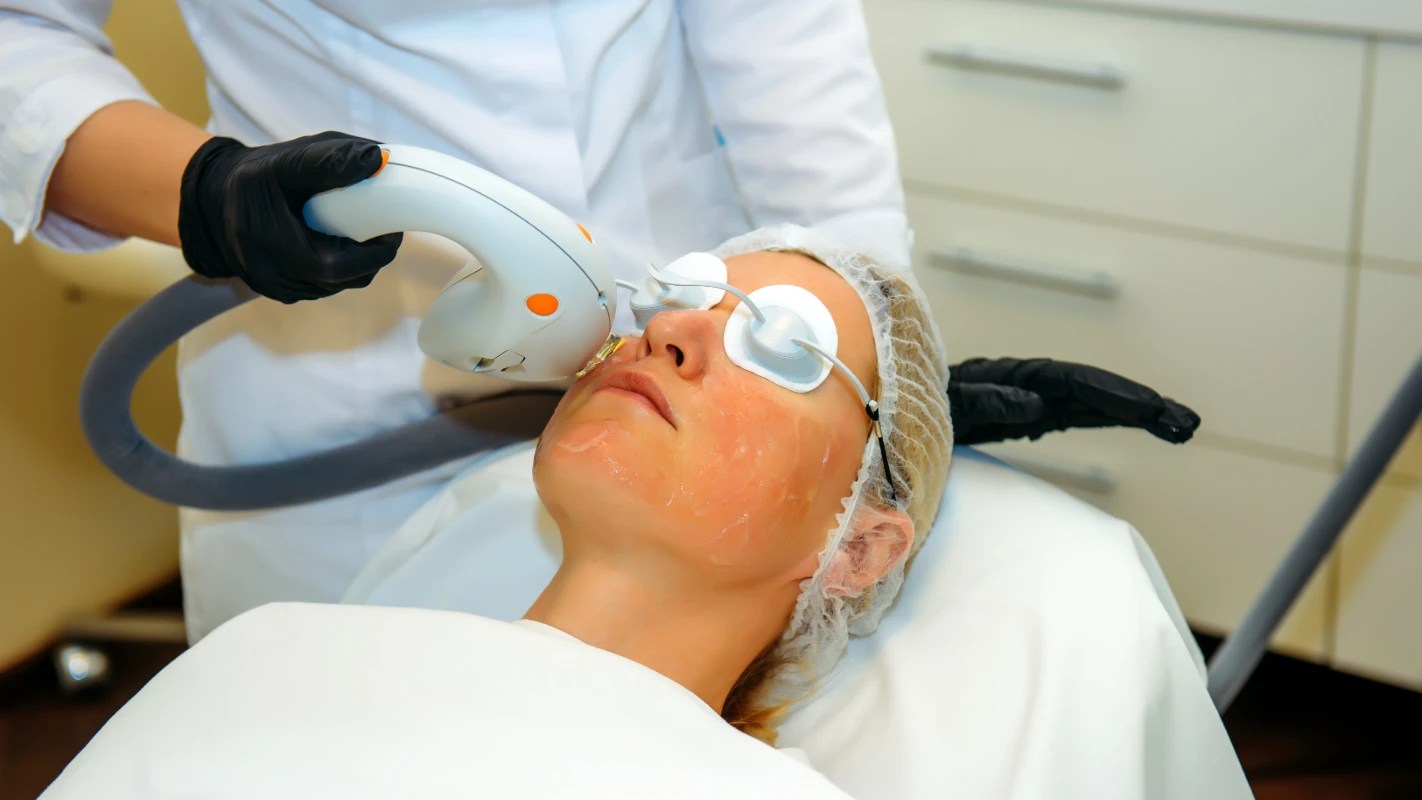 Rosacea Laser Treatment HM Advanced Skin & Lash Spa