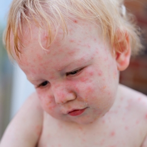 Hand, Foot, And Mouth Disease | Hoag Medical Group