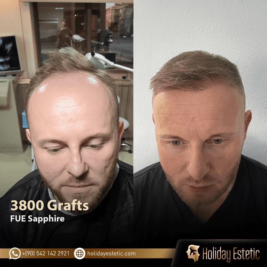 Haartransplantation Holiday Estetic