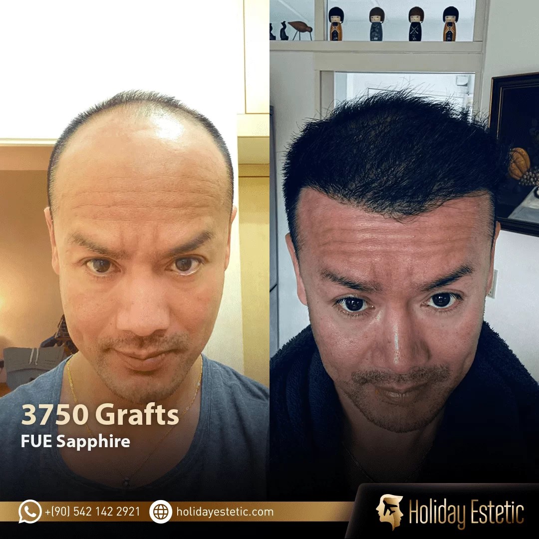 Haartransplantation Holiday Estetic