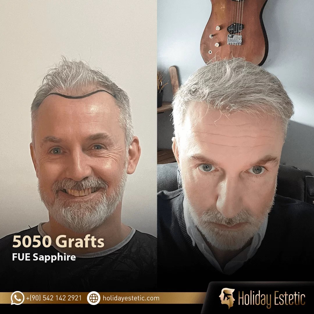 Haartransplantation Holiday Estetic