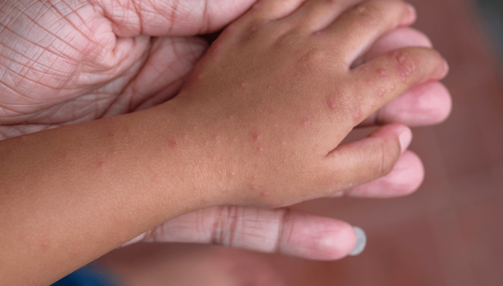 HandFootandMouth Disease A Comprehensive Guide