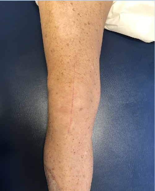 Use of a Subcuticular Suture to Close Hip and Knee Incisions and