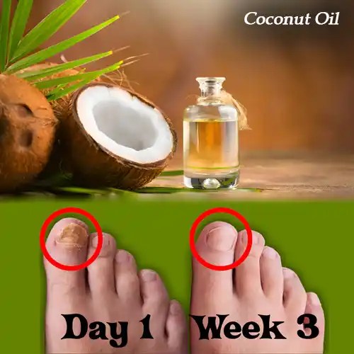 7 Easy Home Remedies for Toenail Fungus Treatment 2024