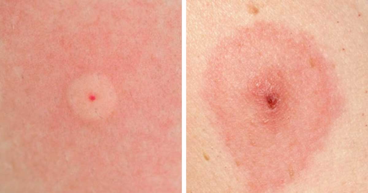 How To Identify 10 Of The Most Common Bug Bites