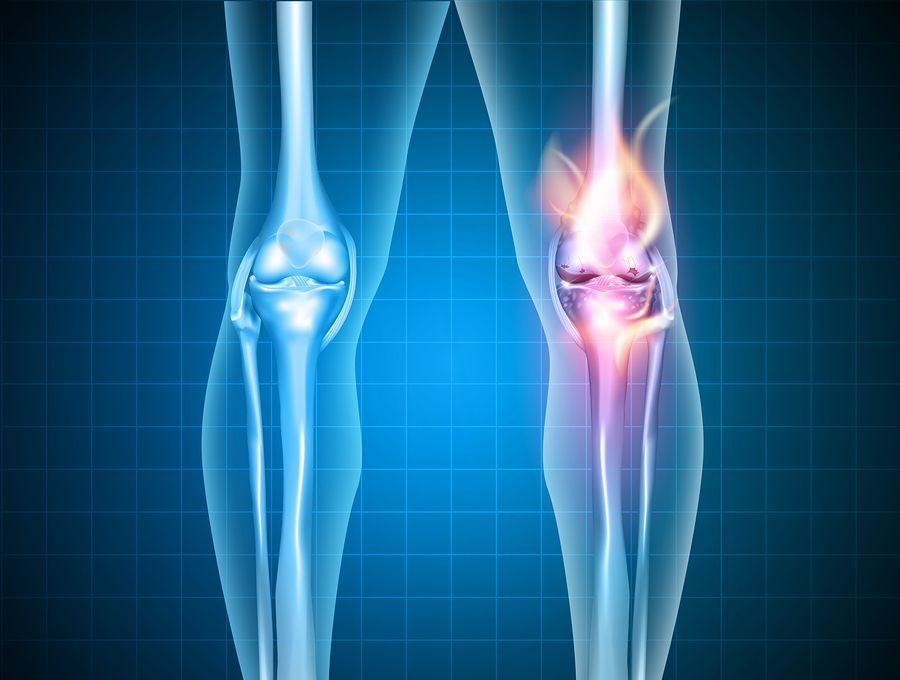 Homeopathy For 'Still's Disease Homeopathy Plus