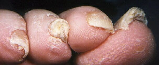 How to Get Rid of Yellow Toenails Nail Fungus Treatment