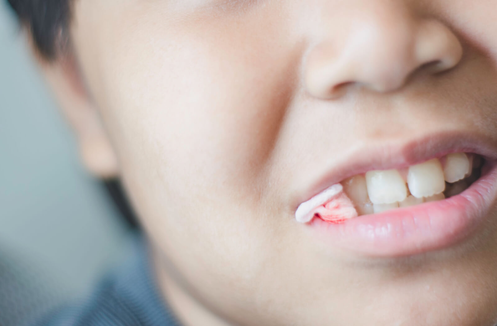 When to Stop Using Gauze After Tooth Extraction Okotoks