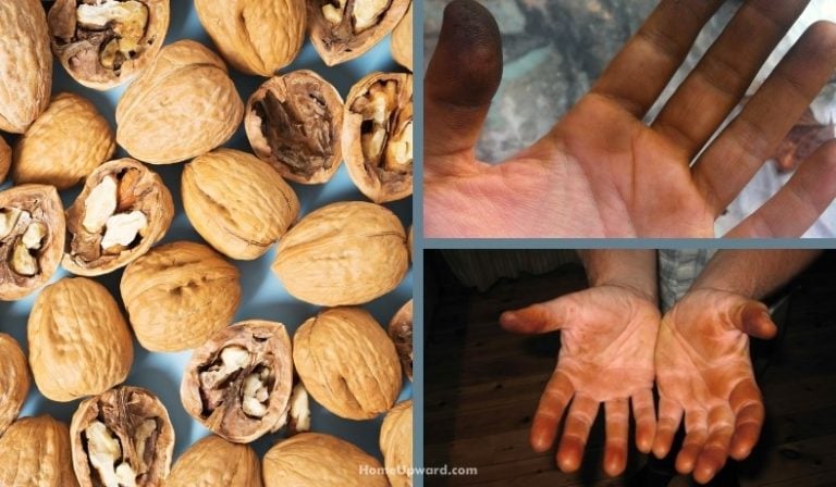 How To Remove Walnut Stains From Skin