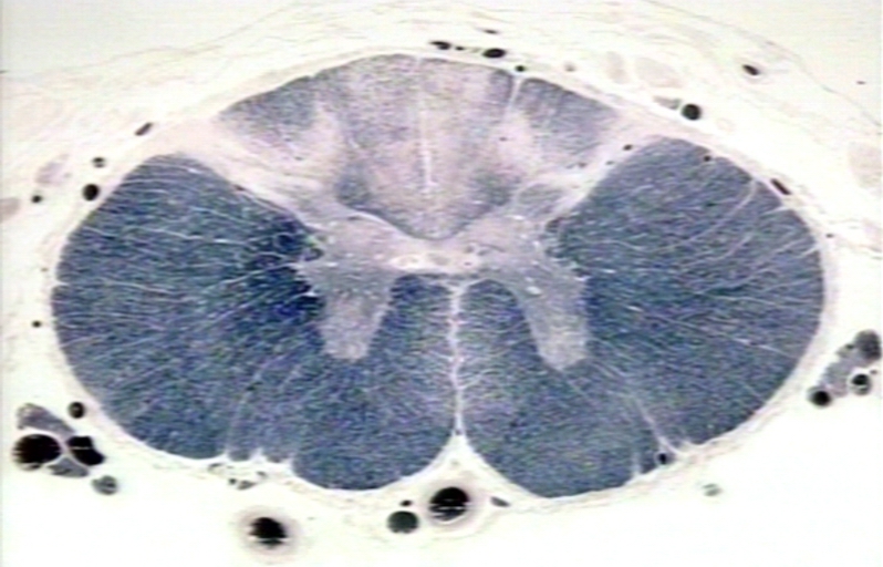 ¿Qué es Tabes dorsal? Homo medicus