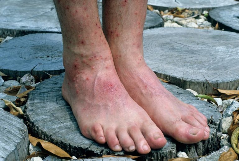 How Long Do Chiggers Live on Clothes Honor Services