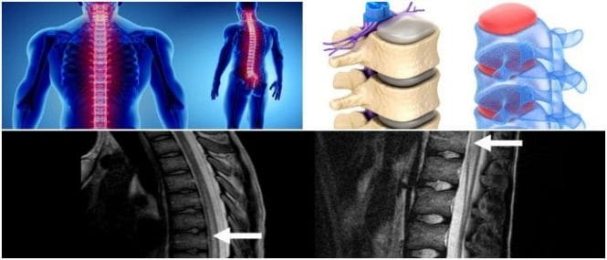 Transverse Myelitis Causes, Symptoms, Diagnosis, and Treatment Hoool Health & Wellness