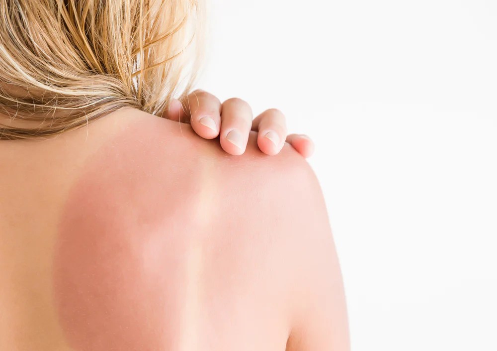 Ultimate Guide How to Stop Peeling from Sunburn and Restore Radiant