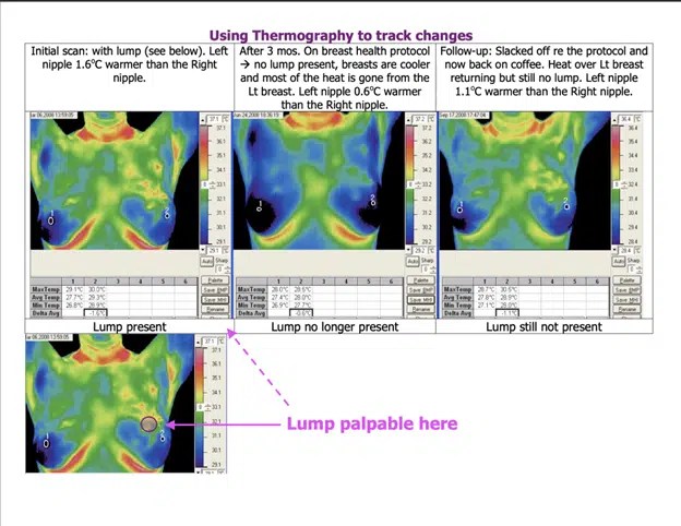 Thermography The Breast Cancer Detection Method You Haven’t Heard of