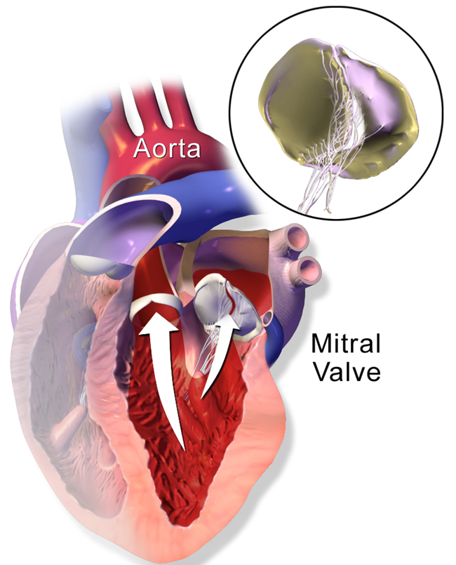 Mitral Valve Prolapse and Dysautonomia Hormones Matter