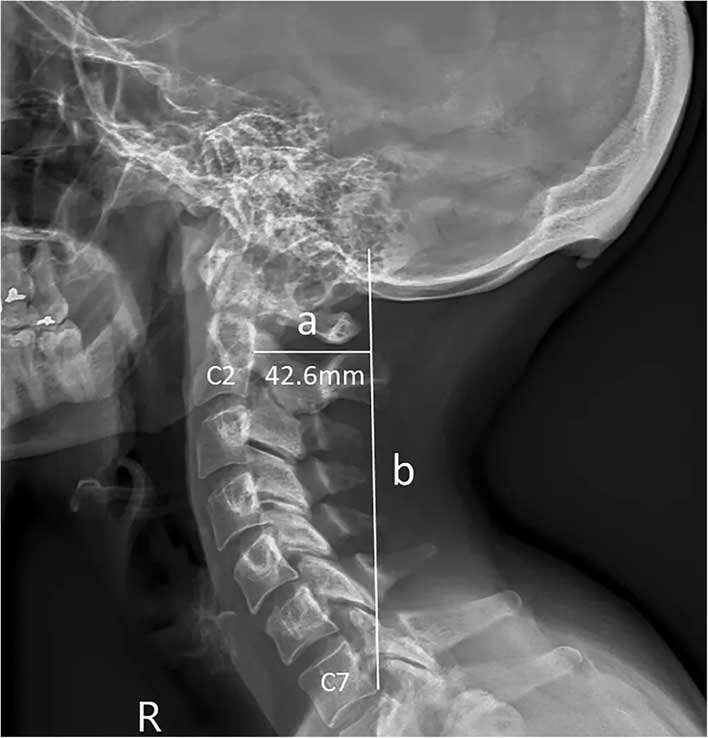 (Updated) Researchers Claim Horns Are Growing In The Back